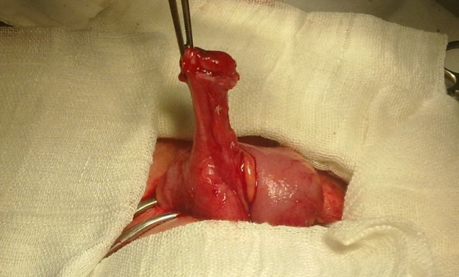 Late Postappendectomy Faecal Fistula