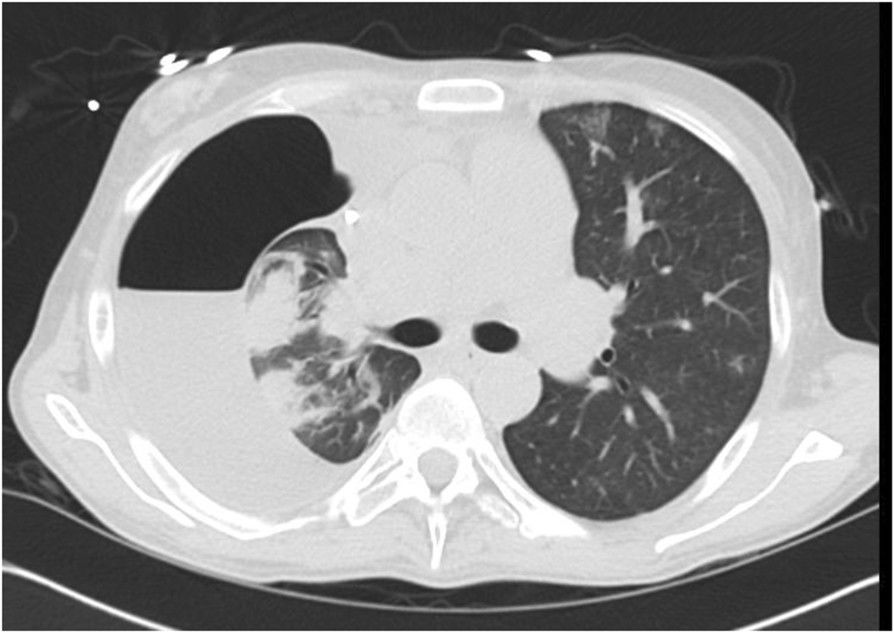 Pneumothorax Ex Vacuo Following Thoracentesis for Persistent Pleural Effusion