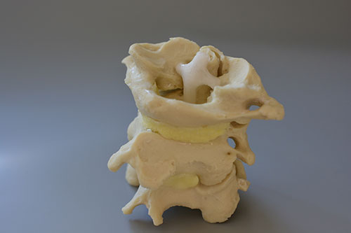 Aneurysmal Bone Cyst of the Upper Cervical Spine in a Child: A Case Report