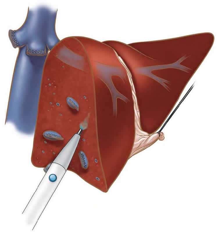 Comparison of Hemostatic Oppel and Cold Plasma Device for Partial Hepatectomy