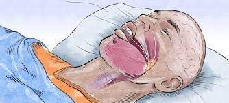 Visualizing of Upper Respiratory Tract During Sleep