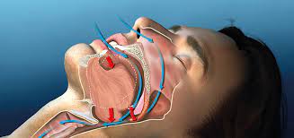 Anti-Snoring Mouthpiece to Reduce Snoring and Treatment Options for Good Sleep