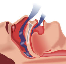 Breathing disorder characterized by upper airway obstruction during the sleep