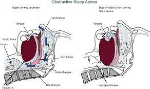 Sleep-Related Breathing Disorder Characterized by Upper Airway Obstruction During Sleep