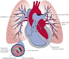 Heart Rate Variability in Pulmonary Hypertension with and without Sleep Apnea