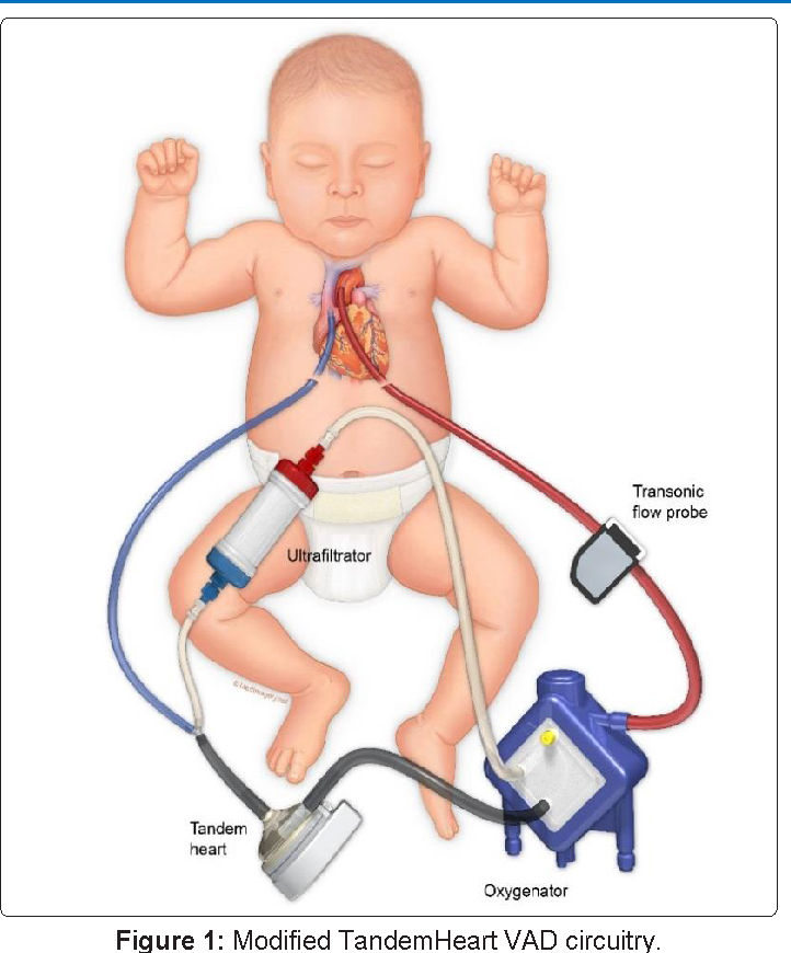 Looking to the Future of  Ventricular Assist Devices in Pediatric Cardiomyopathy