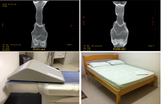 Head of the Bed Elevation: An Alternative Treatment for Obstructive Sleep Apnea