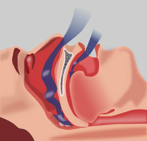 Monosodium Urate as a Biomarker for Obstructive Sleep Apnea