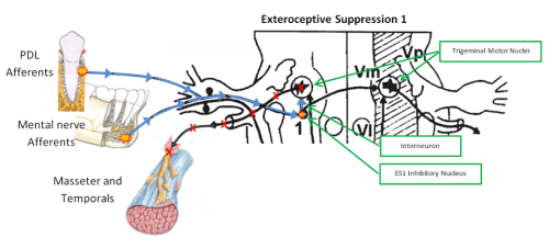 How Sleep Bruxism and Tension Headaches Affect the Masseter Inhibitory Reflex