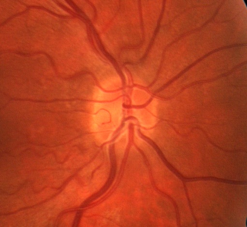 Obstructive Sleep Apnea in a Patient with Bilateral, Sequential Non-Arteritic Anterior Ischemic Optic Neuropathy