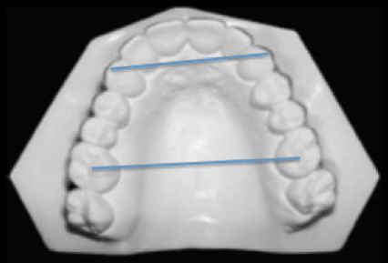 Cephalometric and Dental Measures as Diagnostic Tools for the Obstructive Sleep Apnea