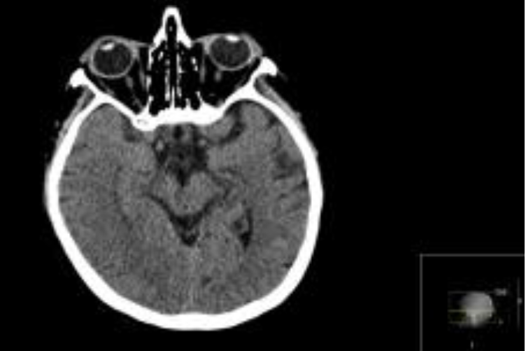 Brain Lesions and Sleep Onset REM Periods in Routine EEG