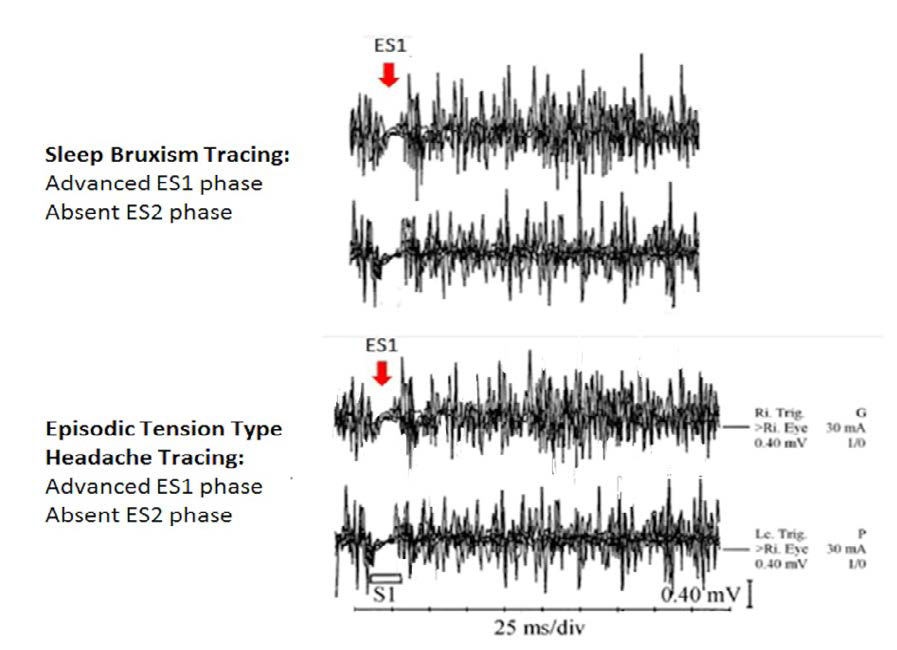 Short-Term Effects of the Luco Hybrid Obstructive Sleep Apnea Appliance in Adults with Sleep Bruxism: A Quasi-Experimental Study