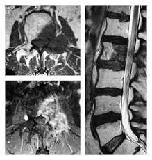 Primary Ewing's Sarcoma of the Mobile Spine in Adult Patients: A Case Report and Literature Review