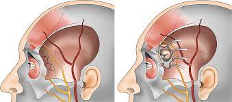 Neurosurgery in Parkinson's Disease: Levodopa Treatment