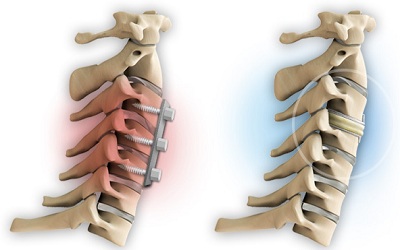 Pain Outcomes in Patients after Artificial Disc Replacement versus Fusion in the Cervical Spine: A Systematic Review of Systematic Reviews