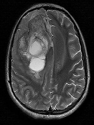 Primary Extradural Peripheral Primitive Neuroectodermal Tumor (Extraskeltal Ewingâ€™s Sarcoma) Arising from the Sacral Spinal Nerve Root: A Case Report and Review of the Literature