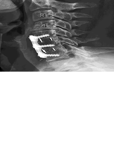 Early Outcomes of Anterior Cervical Discectomy and Fusion Using a Porous PEEK Interbody Fusion Device