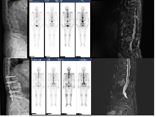 Neoadjuvant Stereotactic Body Radiation Therapy for Spine Metastases