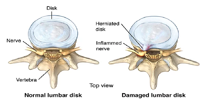 True Recurrent Lumbar Disc Herniation And Arterial Hypertension: Is There Any Relation?