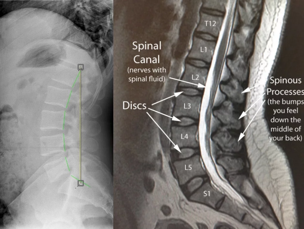 The Clinical Outcomes Of Patients With L1-L2 Disc Herniation Treated By Microsurgical Trans Facet Approach