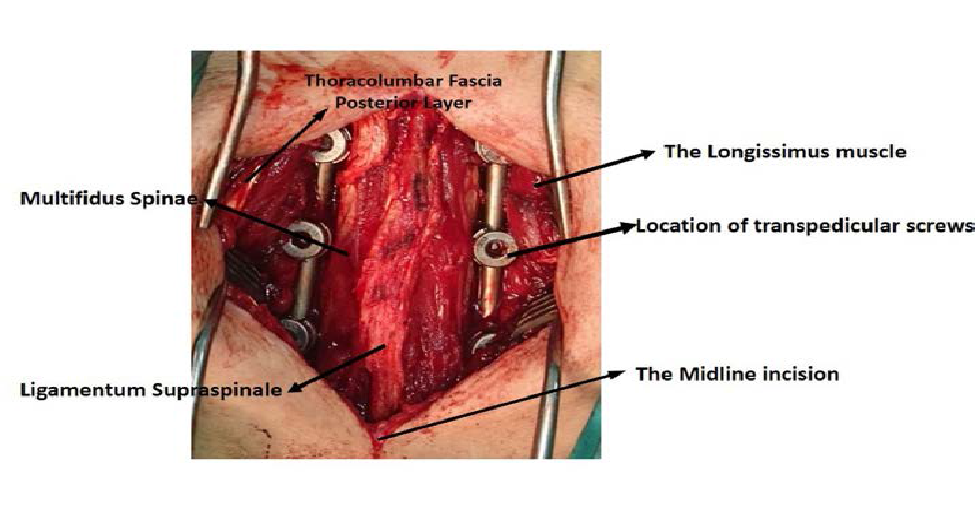 Protection of Paravertebral Muscles and Short Segment Stabilization in Surgical Treatment of Thoracic and Lumbar Compression Fractures