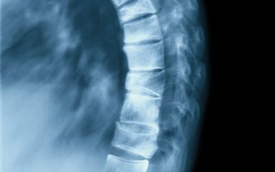 A Single Sagittal Parameter for Decision Making in Adult Spinal Deformity