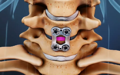 Anterior Cervical Discectomy and Fusion Using Porous PEEK Implants at Levels Adjacent to a Previous Fusion