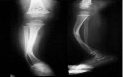 Complex radiological findings in congenital pseudarthrosis of the tibia