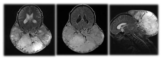 Proliferating Trichilemmal Tumor:
A Case Report and Literature
Review