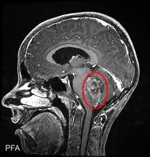 Associated Holocord Syringomyelia with Intramedullary Ependymoma