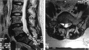 Acute Radicular Symptoms Due to Hemorrhage into Synovial Cysts