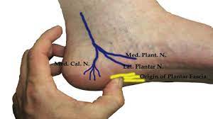 Trauma, the Inferior Calcaneal Nerve Becomes Entrapped