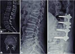 Treatment of Unstable Thoracolumbar Burst Fractures