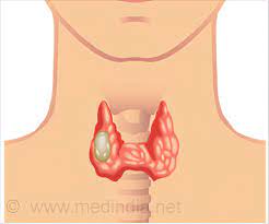 Compressive Myelopathy Due to Follicular Thyroid Carcinoma