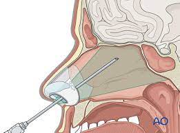 Lumbar Drainage in a Cranial Traumatic CSF Fistula