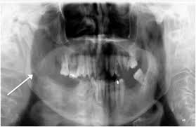 Odontogenic Brain Abscess Caused by Streptococcus Parasanguinis