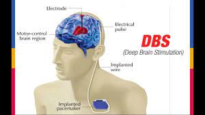 Deep Brain Stimulation and Propionibacterium Acnes Infection with Intracerebral Abscess