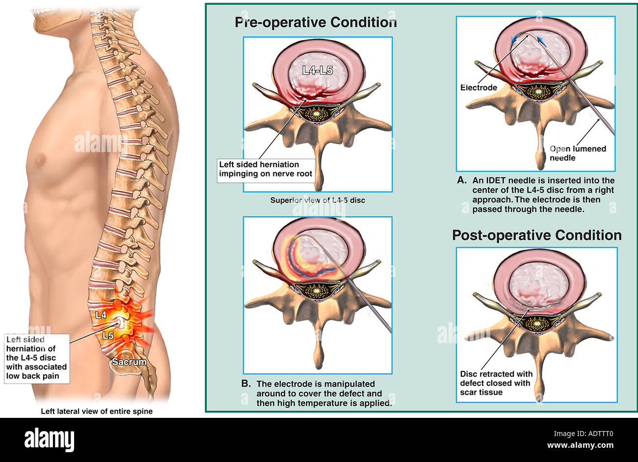 Intradiscal Therapy and Nucleus Augmentation as a Surgical Technique