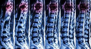 Avascular Necrosis of a Lumbar  Vertebral Body