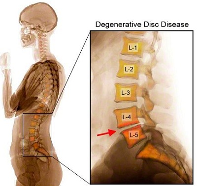 Current Alternatives for Treatment of Degenerative Spinal Disc Disease