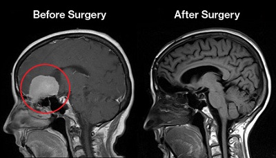 Acute Hemorrhage Following Gamma Knife Radiosurgery to a Clival Meningioma