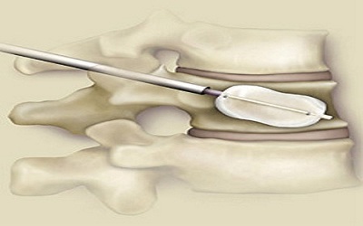 Microsurgical Decompression and Targeted Radiofrequency Ablation and Radiofrequency Sacrum-Kyphoplasty Combined As Palliative Treatment for Sacrum Metastases