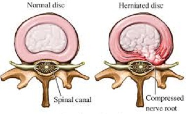 Diagnostic Value of Transforaminal Injections of Steroids in Recurrent Disc Herniations