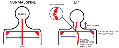 Clinical Implications of the Rare Anomaly of a Cervical Hemivertebra over a Period of 30 Year