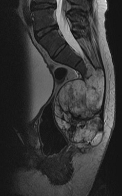Spinal Cord Stimulation for Pain Relief of Unresectable Sacral Chordoma: Case Report