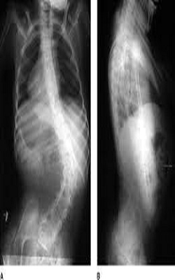 The Etiology And Prognosis Of C5 Palsy After Anterior Decompression With Spinal Fusion