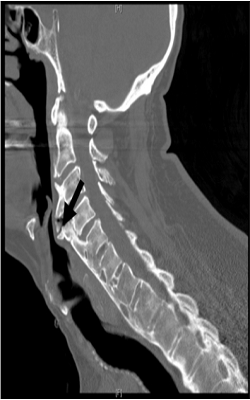 Esophageal Impingement from Anterior Cervical Osteophytes Associated with Cervical Spondylosis