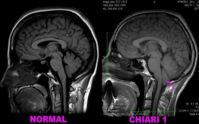 Innovative Treatment for Pre- Operative Occipital Nerve Pain Associated with Chiari 0 Malformation