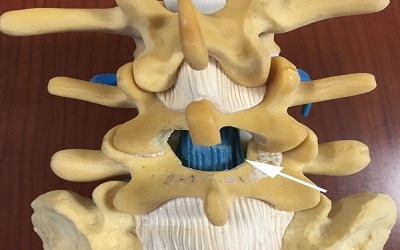 Ossification Of The Ligamentum Flavum Of The Lumbar Spine In Caucasians: Case Series